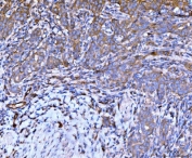 IHC staining of FFPE human metaplasia of squamous cells of the renal pelvis tissue with Filamin B antibody. HIER: boil tissue sections in pH8 EDTA for 20 min and allow to cool before testing.