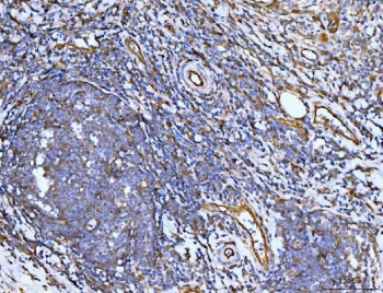 IHC staining of FFPE human lymph node metastases in rectal cancer tissue with Filamin B antibody. HIER: boil tissue sections in pH8 EDTA for 20 min and allow to cool before testing.