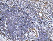 IHC staining of FFPE human lymph node metastases in rectal cancer tissue with Filamin B antibody. HIER: boil tissue sections in pH8 EDTA for 20 min and allow to cool before testing.