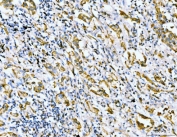 IHC staining of FFPE human lung cancer tissue with Filamin B antibody. HIER: boil tissue sections in pH8 EDTA for 20 min and allow to cool before testing.