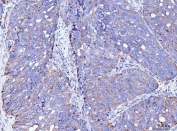 IHC staining of FFPE human ovarian cancer tissue with ACSL4 antibody. HIER: boil tissue sections in pH8 EDTA for 20 min and allow to cool before testing.