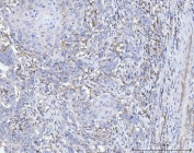 IHC staining of FFPE metaplasia of squamous cells of the renal pelvis tissue with ACSL4 antibody. HIER: boil tissue sections in pH8 EDTA for 20 min and allow to cool before testing.