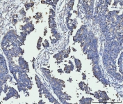 IHC staining of FFPE human bladder epithelial carcinoma tissue with ACSL4 antibody. HIER: boil tissue sections in pH8 EDTA for 20 min and allow to cool before testing.