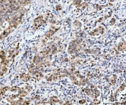 IHC staining of FFPE metaplasia of squamous cells of the renal pelvis tissue with Neurofibromin antibody. HIER: boil tissue sections in pH8 EDTA for 20 min and allow to cool before testing.