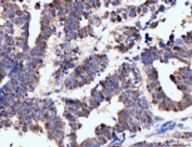 IHC staining of FFPE human ovarian cancer tissue with Neurofibromin antibody. HIER: boil tissue sections in pH8 EDTA for 20 min and allow to cool before testing.