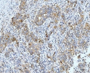 IHC staining of FFPE metaplasia of squamous cells of the renal pelvis tissue with NF1 antibody. HIER: boil tissue sections in pH8 EDTA for 20 min and allow to cool before testing.