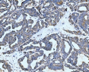 IHC staining of FFPE human ovarian cancer tissue with NF1 antibody. HIER: boil tissue sections in pH8 EDTA for 20 min and allow to cool before testing.