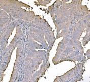 IHC staining of FFPE differentiated adenocarcinoma of the human rectum tissue with Pyruvate Kinase antibody. HIER: boil tissue sections in pH8 EDTA for 20 min and allow to cool before testing.