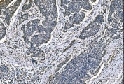 IHC staining of FFPE human bladder epithelial carcinoma tissue with Dynein light chain 1 antibody. HIER: boil tissue sections in pH8 EDTA for 20 min and allow to cool before testing.