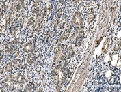 IHC staining of FFPE metaplasia of squamous cells of the renal pelvis tissue with Dynein light chain 1 antibody. HIER: boil tissue sections in pH8 EDTA for 20 min and allow to cool before testing.