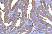 IHC staining of FFPE human rectum adenocarcinoma tissue with RLIP1 antibody. HIER: boil tissue sections in pH8 EDTA for 20 min and allow to cool before testing.