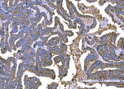IHC staining of FFPE human ovarian cancer tissue with RLIP1 antibody. HIER: boil tissue sections in pH8 EDTA for 20 min and allow to cool before testing.