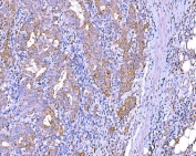 IHC staining of FFPE metaplasia of squamous cells of the renal pelvis tissue with RLIP1 antibody. HIER: boil tissue sections in pH8 EDTA for 20 min and allow to cool before testing.