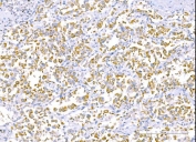 IHC staining of FFPE human lung cancer tissue with RLIP1 antibody. HIER: boil tissue sections in pH8 EDTA for 20 min and allow to cool before testing.