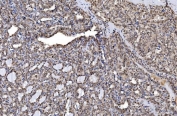 IHC staining of FFPE Hashimoto's thyroiditis tissue with Aurora A antibody. HIER: boil tissue sections in pH8 EDTA for 20 min and allow to cool before testing.