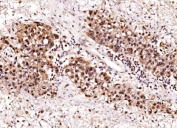 IHC staining of FFPE human liver cancer tissue with Aurora A antibody. HIER: boil tissue sections in pH8 EDTA for 20 min and allow to cool before testing.