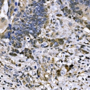 IHC staining of FFPE human bladder cancer tissue with BUB1 antibody. HIER: boil tissue sections in pH8 EDTA for 20 min and allow to cool before testing.