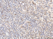 IHC staining of FFPE human gall bladder adenosquamous carcinoma tissue with CD93 antibody. HIER: boil tissue sections in pH8 EDTA for 20 min and allow to cool before testing.