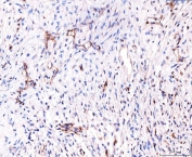 IHC staining of FFPE human breast cancer tissue with CD93 antibody. HIER: boil tissue sections in pH8 EDTA for 20 min and allow to cool before testing.