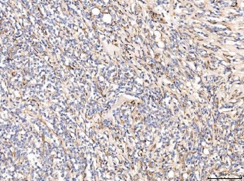 IHC staining of FFPE human gall bladder adenosquamous carcinoma tissue with CD93 antibody. HIER: boil tissue sections in pH8 EDTA for 20 min and allow to cool before testing.