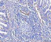 IHC staining of FFPE human gastric adenocarcinoma tissue with CD93 antibody. HIER: boil tissue sections in pH8 EDTA for 20 min and allow to cool before testing.
