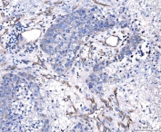 IHC staining of FFPE human liver cancer tissue with CD93 antibody. HIER: boil tissue sections in pH8 EDTA for 20 min and allow to cool before testing.