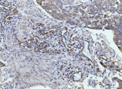 IHC staining of FFPE human colonic adenocarcinoma tissue with CD93 antibody. HIER: boil tissue sections in pH8 EDTA for 20 min and allow to cool before testing.