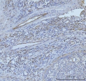 IHC staining of FFPE human lung cancer tissue with CD93 antibody. HIER: boil tissue sections in pH8 EDTA for 20 min and allow to cool before testing.