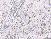 IHC staining of FFPE human appendiceal adenocarcinoma tissue with CD93 antibody. HIER: boil tissue sections in pH8 EDTA for 20 min and allow to cool before testing.
