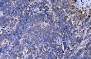 IHC staining of FFPE human ovarian serous adenocarcinoma tissue with MENA antibody. HIER: boil tissue sections in pH8 EDTA for 20 min and allow to cool before testing.