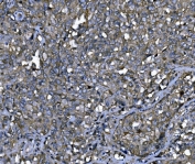 IHC staining of FFPE metaplasia of squamous cells of the renal pelvis tissue with MENA antibody. HIER: boil tissue sections in pH8 EDTA for 20 min and allow to cool before testing.