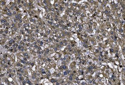 IHC staining of FFPE human liver cancer tissue with MENA antibody. HIER: boil tissue sections in pH8 EDTA for 20 min and allow to cool before testing.