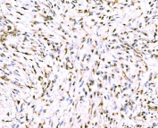 IHC staining of FFPE human breast cancer tissue with Giantin antibody. HIER: boil tissue sections in pH8 EDTA for 20 min and allow to cool before testing.