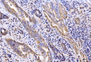 IHC staining of FFPE human gall bladder adenosquamous carcinoma tissue with Giantin antibody. HIER: boil tissue sections in pH8 EDTA for 20 min and allow to cool before testing.