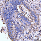 IHC staining of FFPE human appendiceal adenocarcinoma tissue with Giantin antibody. HIER: boil tissue sections in pH8 EDTA for 20 min and allow to cool before testing.