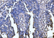 IHC staining of FFPE human colonic adenocarcinoma tissue with Giantin antibody. HIER: boil tissue sections in pH8 EDTA for 20 min and allow to cool before testing.