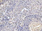 IHC staining of FFPE human esophageal squamous carcinoma tissue with Giantin antibody. HIER: boil tissue sections in pH8 EDTA for 20 min and allow to cool before testing.