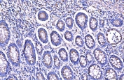 IHC staining of FFPE human gastric adenocarcinoma tissue with Giantin antibody. HIER: boil tissue sections in pH8 EDTA for 20 min and allow to cool before testing.