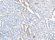 IHC staining of FFPE human renal cancer tissue with Hemoglobin alpha antibody. HIER: boil tissue sections in pH8 EDTA for 20 min and allow to cool before testing.