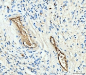 IHC staining of FFPE human gastric signet ring cell carcinoma tissue with Hemoglobin alpha antibody. HIER: boil tissue sections in pH8 EDTA for 20 min and allow to cool before testing.