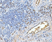 IHC staining of FFPE moderately differentiated adenocarcinoma of the rectum tissue with Hemoglobin alpha antibody. HIER: boil tissue sections in pH8 EDTA for 20 min and allow to cool before testing.