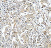 IHC staining of FFPE human liver cancer tissue with Monofunctional C1-tetrahydrofolate synthase antibody, HRP-secondary and DAB substrate. HIER: boil tissue sections in pH8 EDTA for 20 min and allow to cool before testing.