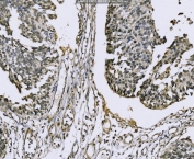 IHC staining of FFPE human bladder epithelial carcinoma with BTBD14B antibody. HIER: boil tissue sections in pH8 EDTA for 20 min and allow to cool before testing.