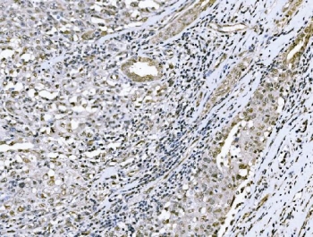 IHC staining of FFPE human renal pelvis squamous metaplasia with BTBD14B antibody. HIER: boil tissue sections in pH8 EDTA for 20 min and allow to cool before testing.