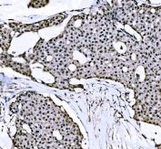 IHC staining of FFPE human papillary carcinoma of the breast with BTBD14B antibody. HIER: boil tissue sections in pH8 EDTA for 20 min and allow to cool before testing.
