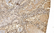 IHC staining of FFPE human renal cancer tissue with PSMD8 antibody. HIER: boil tissue sections in pH8 EDTA for 20 min and allow to cool before testing.
