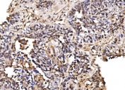 IHC staining of FFPE human lung cancer tissue with PSMD8 antibody. HIER: boil tissue sections in pH8 EDTA for 20 min and allow to cool before testing.