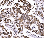 IHC staining of FFPE human breast cancer tissue with PSMD8 antibody. HIER: boil tissue sections in pH8 EDTA for 20 min and allow to cool before testing.