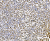 IHC staining of FFPE human liver cancer tissue with CD155 antibody. HIER: boil tissue sections in pH8 EDTA for 20 min and allow to cool before testing.
