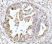 IHC staining of FFPE moderately differentiated adenocarcinoma of the rectum with RPS6KA4 antibody. HIER: boil tissue sections in pH8 EDTA for 20 min and allow to cool before testing.